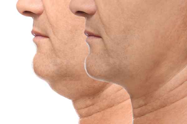 HIFU - Breakthrough in Anti - ageing 2 hifu results Dorset