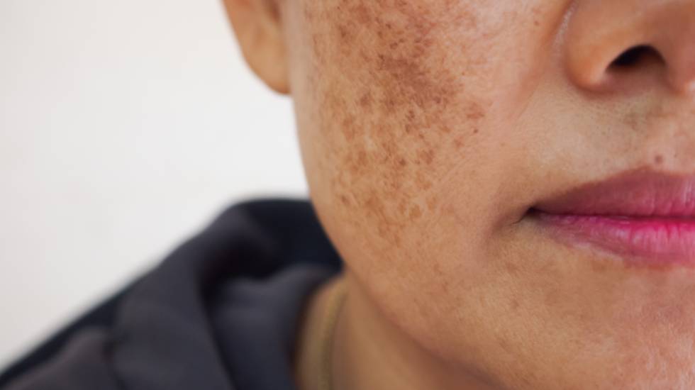 Ephelides Treatment Dorset
