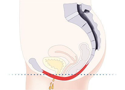Pelvic-Floor Muscle Repair 5 Pelvic floor muscles Dorset