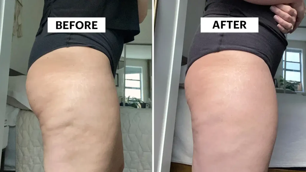 Do Toning Exercise Dorset Really Tackle Cellulite?